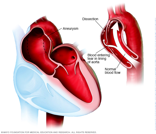 Aort anevrizması ve aort diseksiyonu