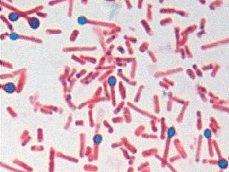 a.  Tip 1 davul sopası şeklindeki Clostridium tetani sporları ve bakterileri, durum 1'de (gram boyama-1000x) kurutucu yaraların kabuğundan izole edilmiştir. 