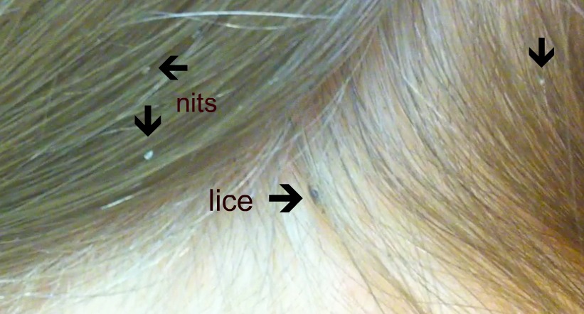 http://mdturk.com/wp-content/uploads/2020/12/head-lice-actual.jpg