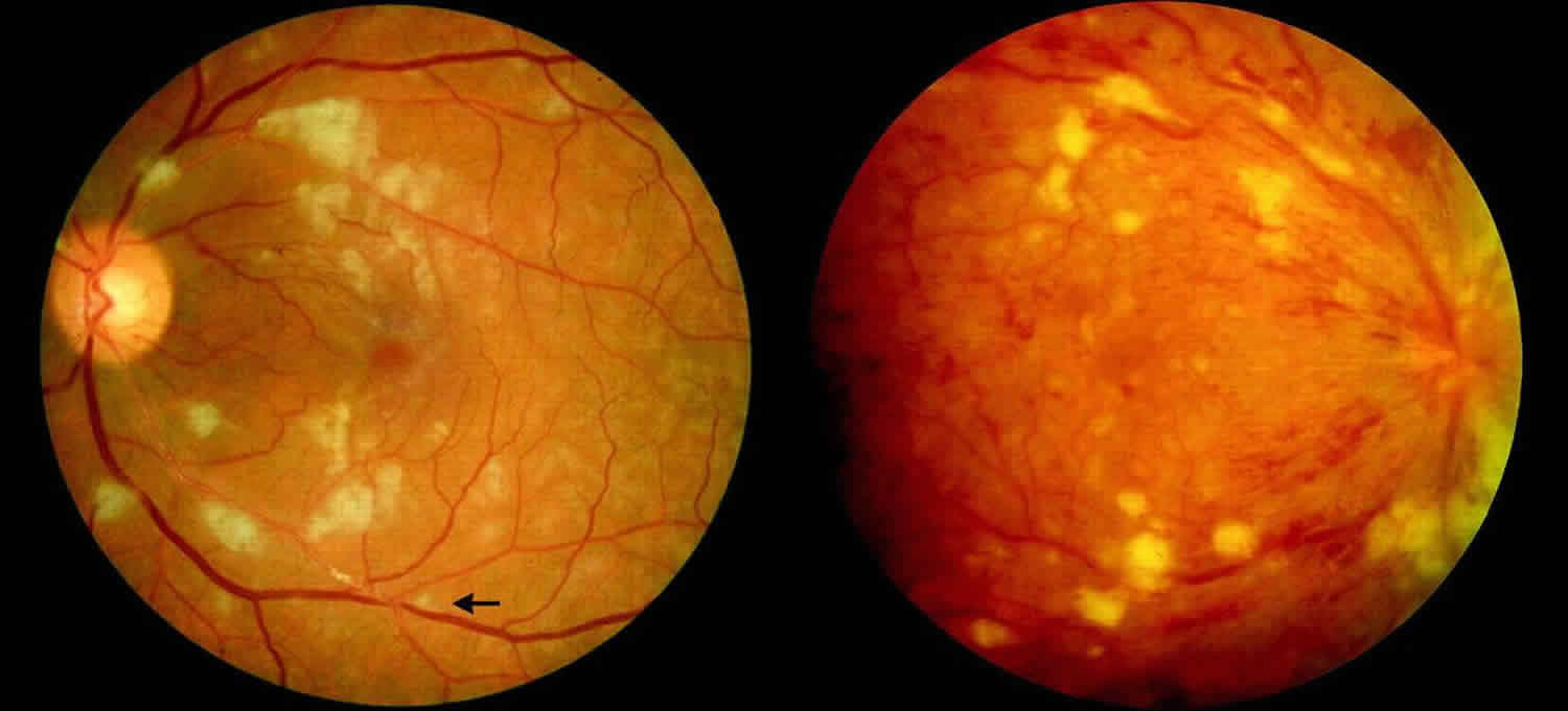 Hepatit B gözlerinizi nasıl etkiler