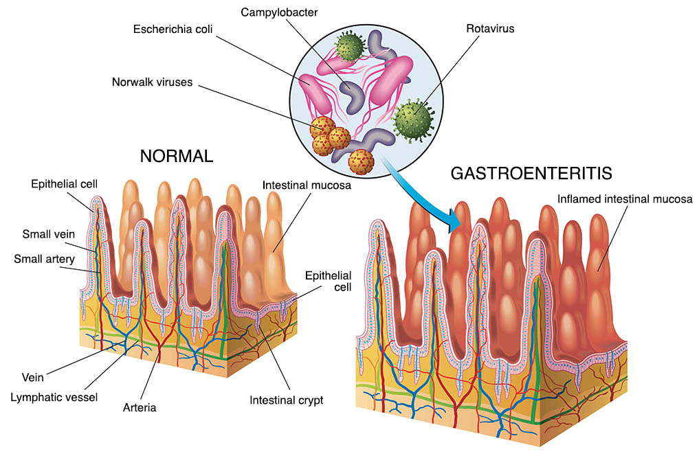 Gastroenterit çizimi