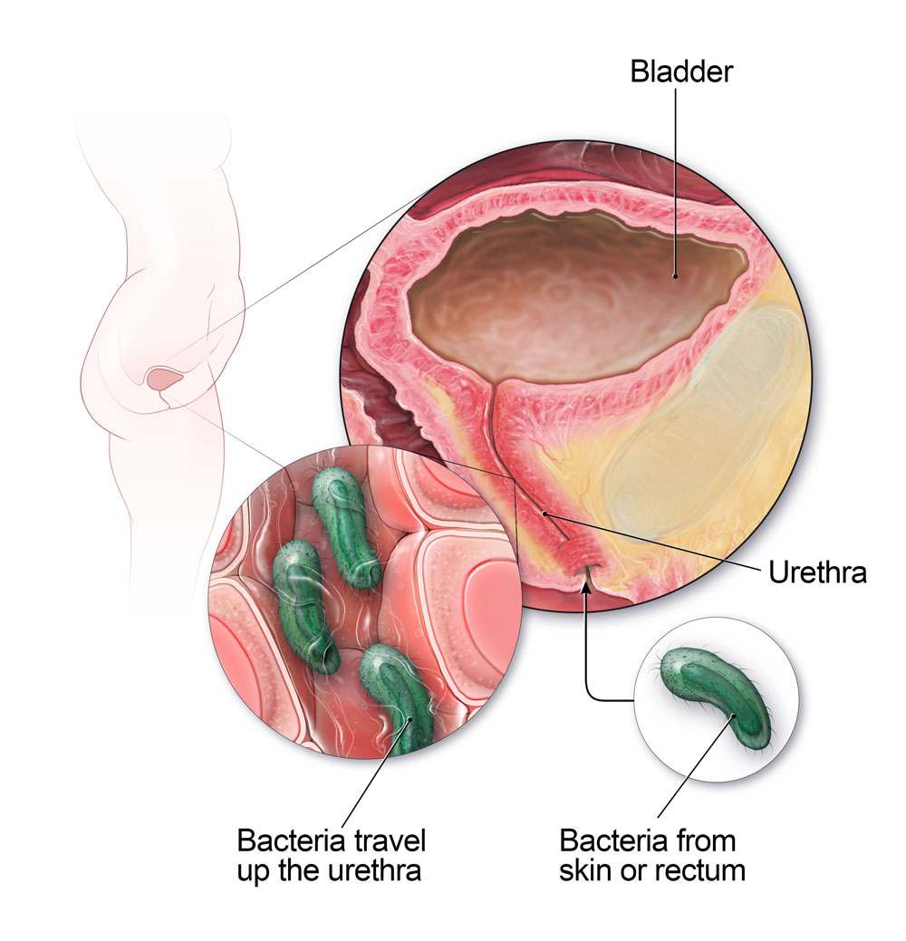 Kadınlarda deri veya rektumdaki bakteriler üretra boyunca ilerleyerek mesane enfeksiyonuna neden olabilir.