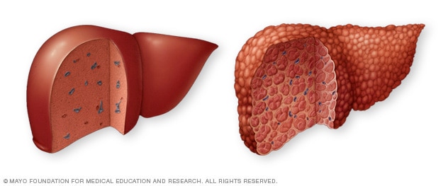 Normal karaciğer ve karaciğer sirozu