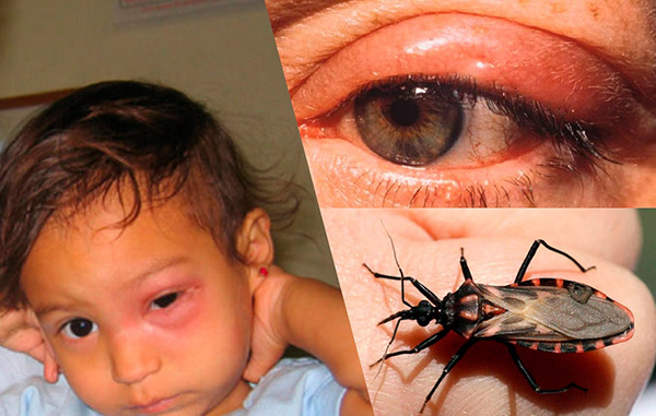 Chagas hastalığı: semptomlar, nedenleri ve tedavisi